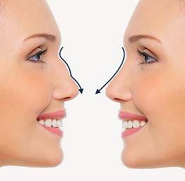 Nose Filler