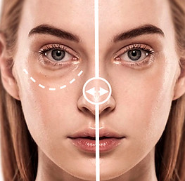 Under Eyes Filler