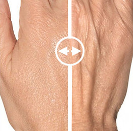 Hand Rejuvenation