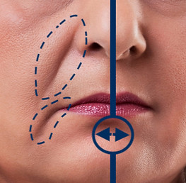 Nasolabial Lines