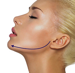 Jawline Filler